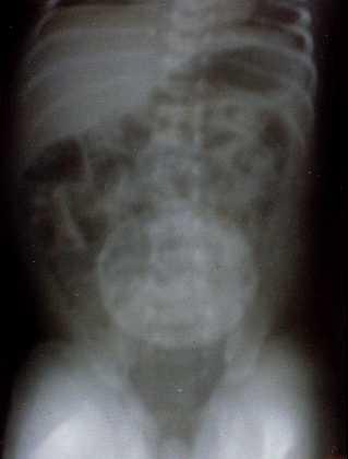 Meningocele Lumbosacral